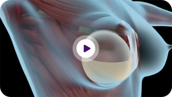 biotech-video-cover-prepectoral
